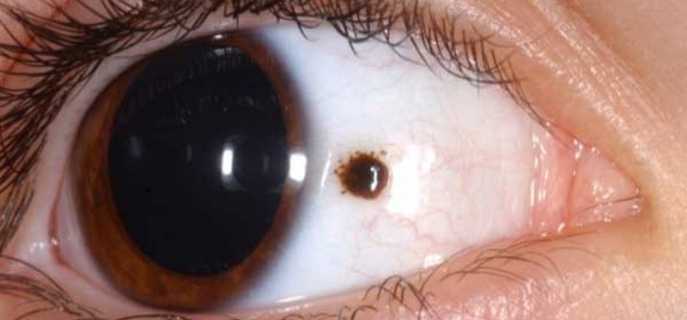 От чего может появиться пятно в глазу, как от него избавиться