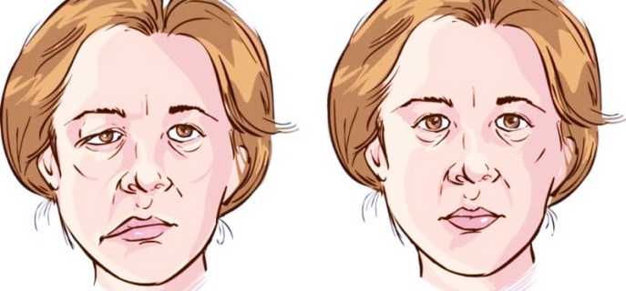 Виды парезов лицевого нерва