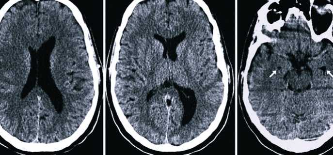 Как проявляется и лечится асимметрия боковых желудочков