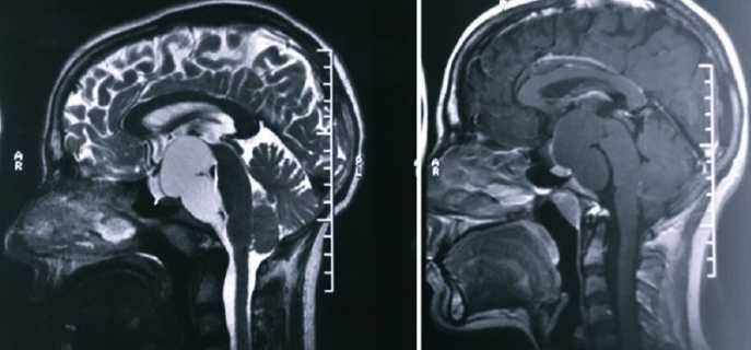 Ретроцеребеллярная киста головного мозга