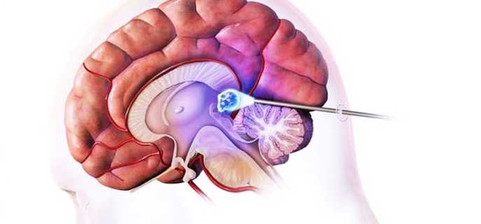 Насколько опасна киста головного мозга
