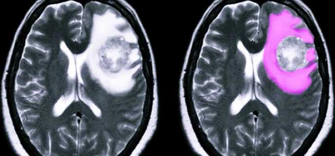 Отек головного мозга