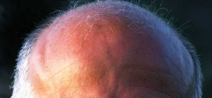 Причины, диагностика и лечение мурашек по голове