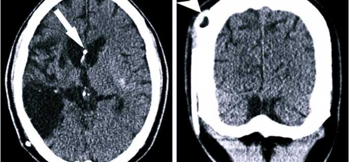 Что такое псевдокиста головного мозга и почему возникает