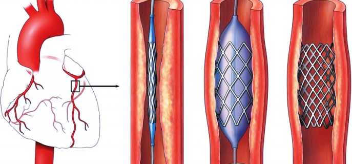 Как вылечить атеросклероз народными средствами и медикаментами