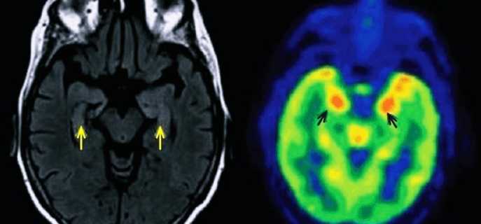 Формы, причины и симптомы энцефалита