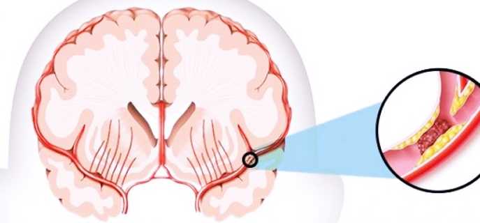 Все про ишемический инсульт
