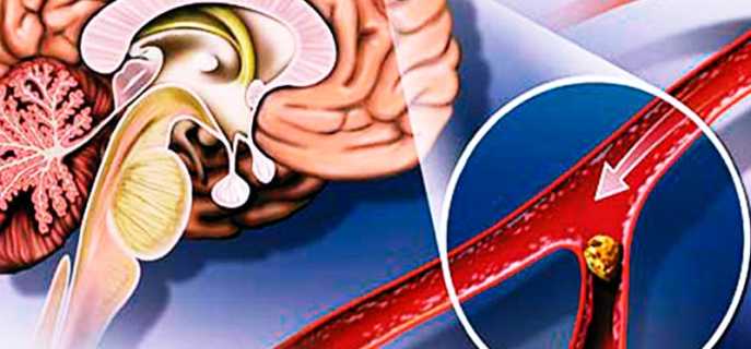 В каких случаях делают шунтирование головного мозга