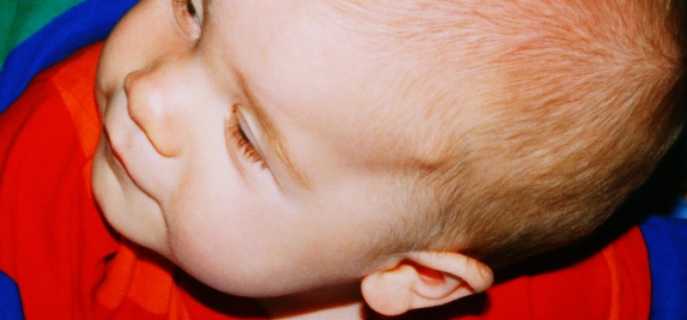 Киста головного мозга у новорожденного