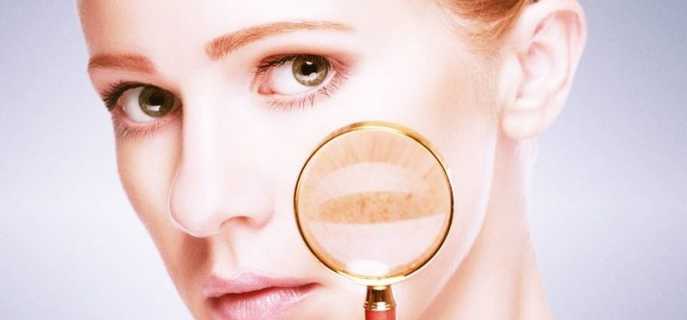 Системная красная волчанка