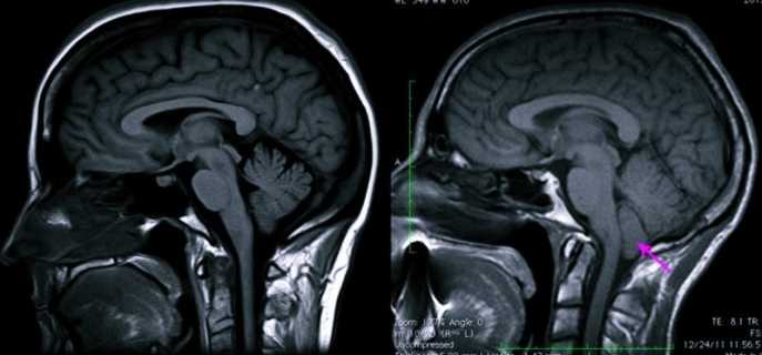 Аномалия Арнольда-Киари