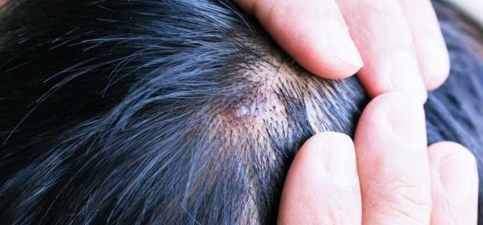 Виды и причины появления шишек на голове в волосах