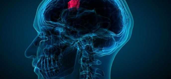 Опухоли головного мозга