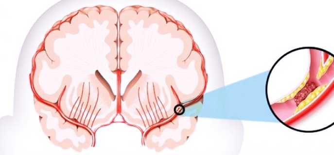 Виды, симптомы и диагностика нарушений мозгового кровообращения