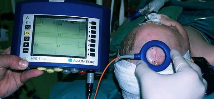 Способы измерить внутричерепное давление
