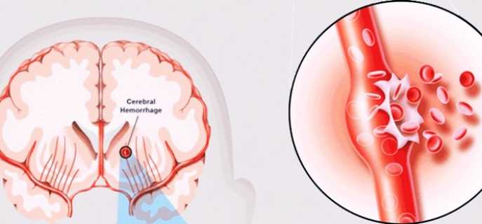 Причины, виды, симптомы и лечение инсультов с кровоизлиянием