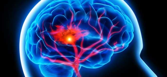 Прогноз после инсульта головного мозга