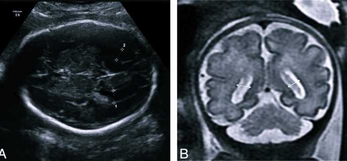 Причины, проявления, диагностика и лечение вентрикуломегалии у плода