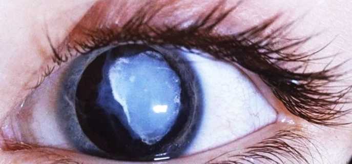 От чего появляется пелена перед глазами