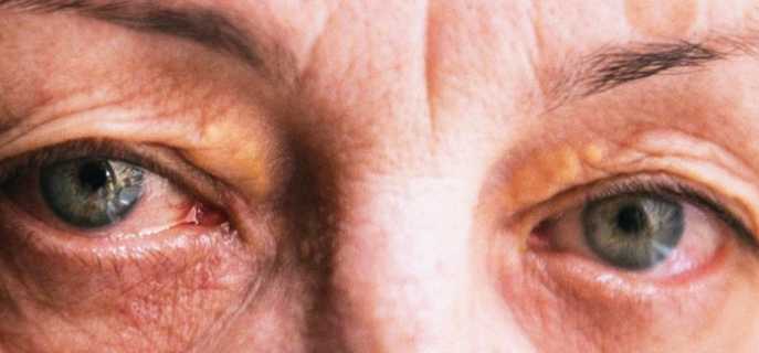 Причины, симптомы и методы избавления от синдрома Шегрена