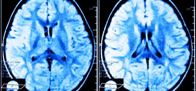 Симптомы и профилактика лейкоэнцефалопатии головного мозга
