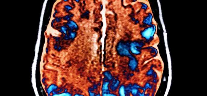 Причины, виды и лечение токсической энцефалопатии