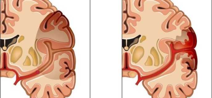 Инфаркт головного мозга