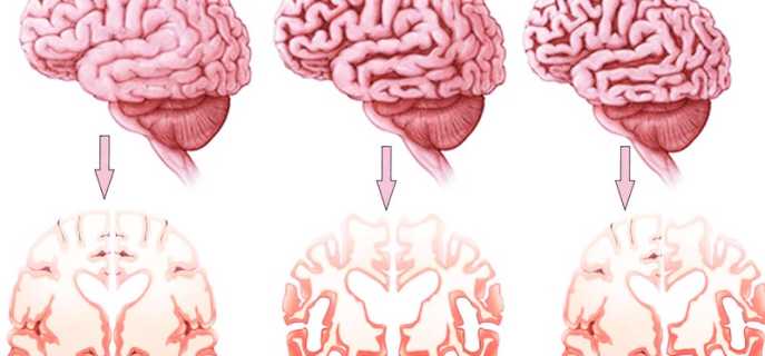 Болезнь Альцгеймера