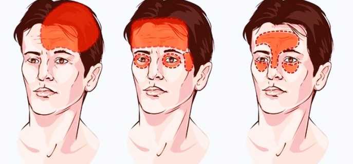 Головные боли в лобной части