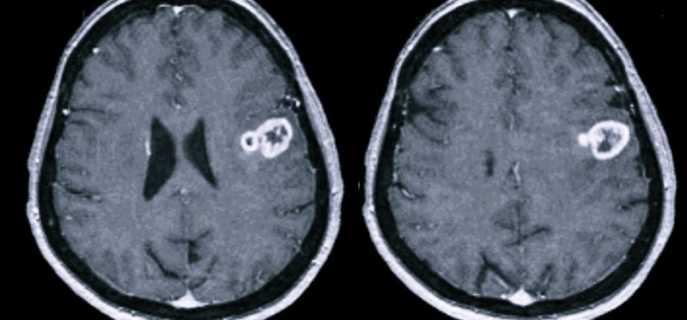 Глиобластома головного мозга человека