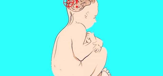 Излечимо ли ДЦП у детей