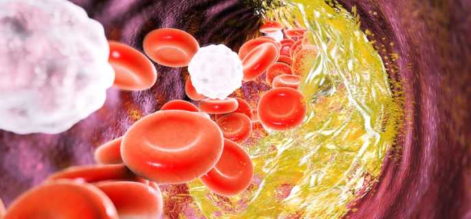 Склероз сосудов головного мозга