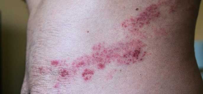 Симптомы и лечение постгерпетической невралгии