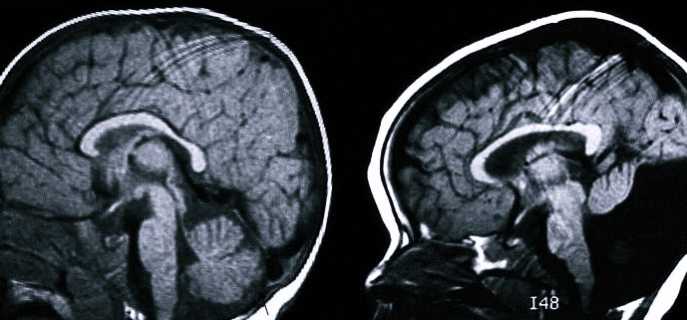 Причины и прогноз для больных синдромом Денди-Уокера