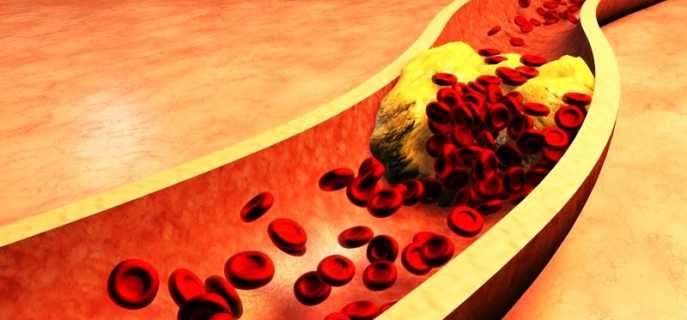 Прогнозы при диагнозе ишемический инсульт головного мозга у пожилых