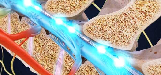 Электрическая стимуляция спинного мозга