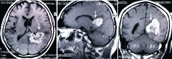 Томограмма