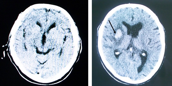 Томограмма