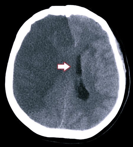 Дислокация