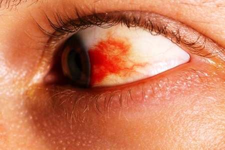 Покраснение