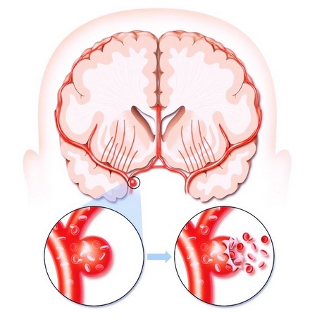 Механизм возникновения