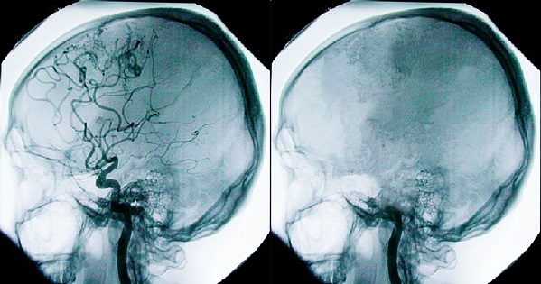 Томограмма