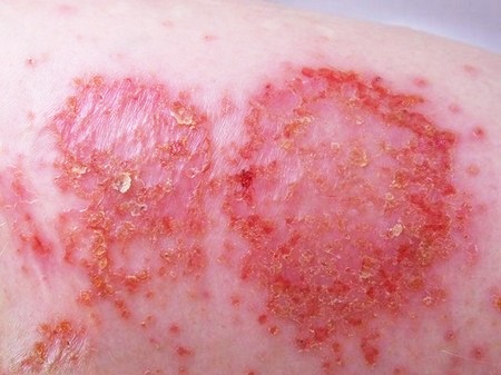 Пораженный участок