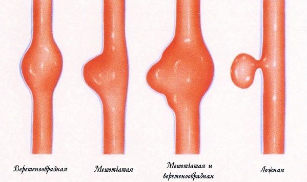 Разновидности