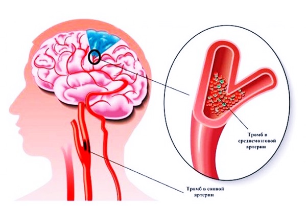 Как возникает