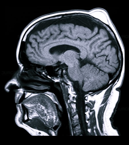 Липома на снимке