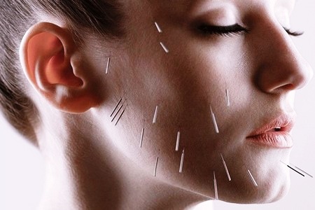 Иглотерапия