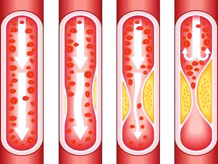 Появление бляшки