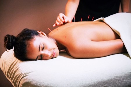 Иглоукалывание