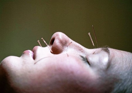 Иглоукалывание